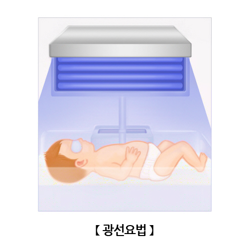 광선요법