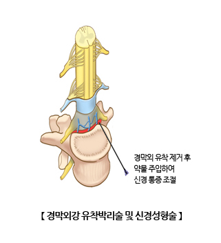 경막외강 유착 박리술 및 신경성형술