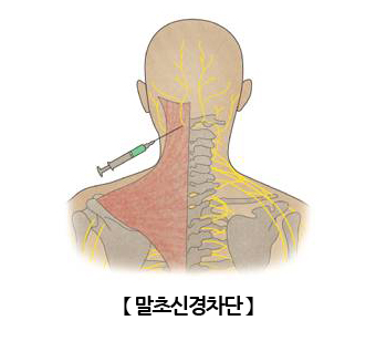 말초신경차단