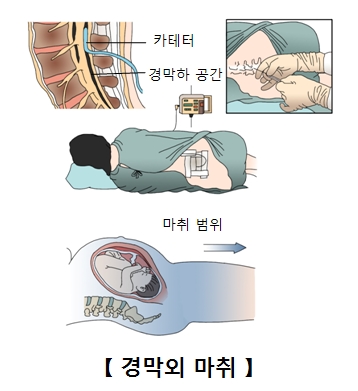 경막외 마취