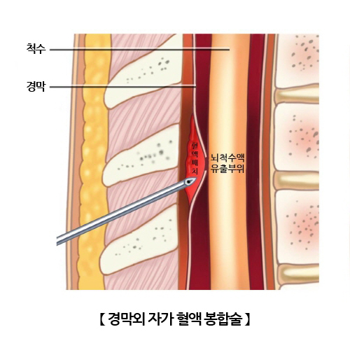 경막외 자가 혈액 봉합술
