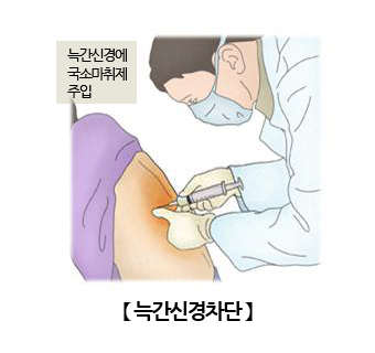 늑간신경차단