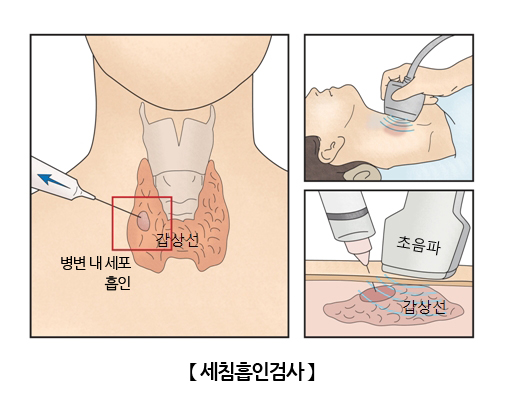 세침흡인검사