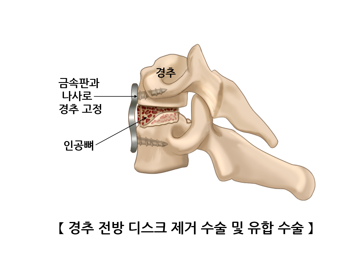 경추 전방 디스크 제거 수술ㆍ유합 수술