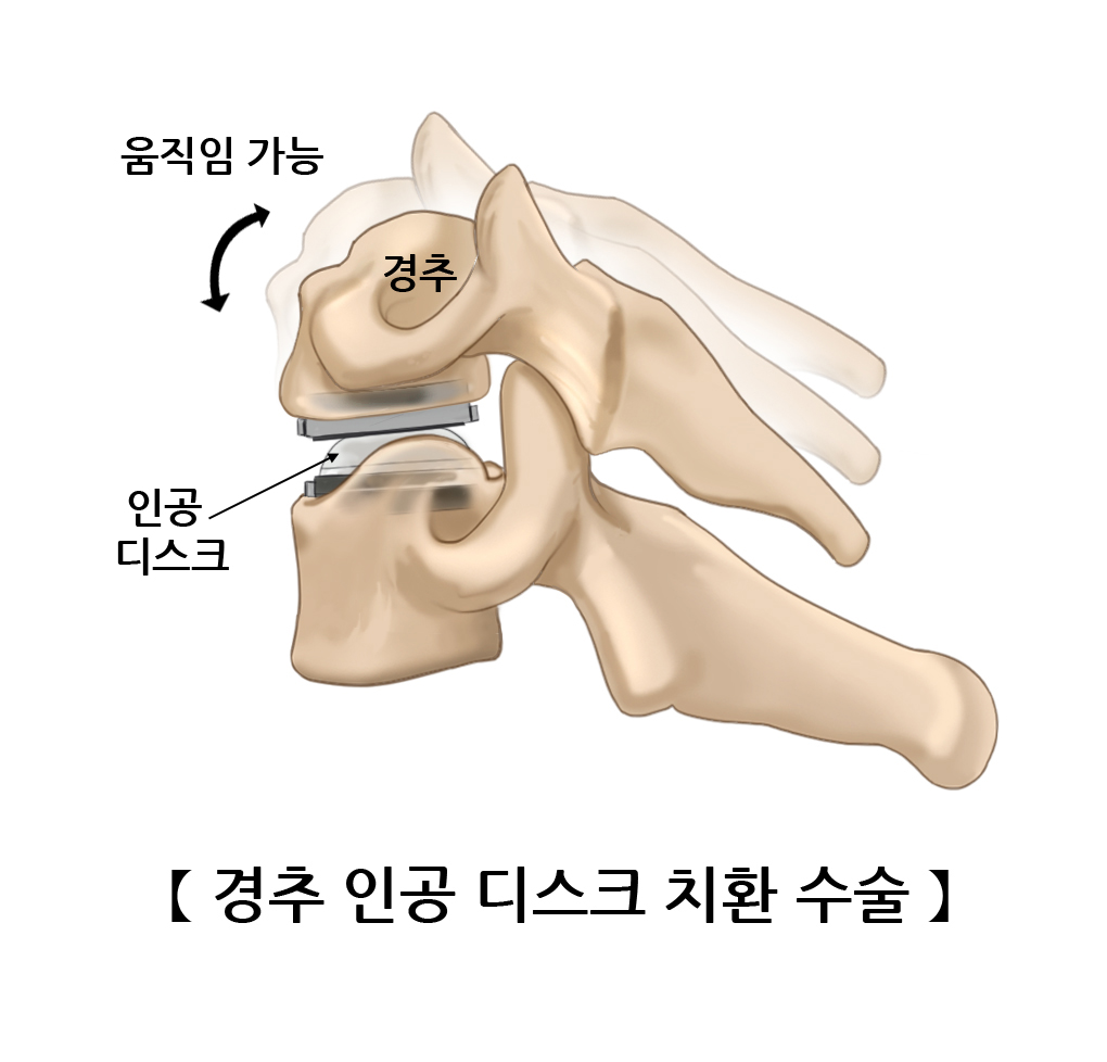 경추 인공 디스크 치환 수술