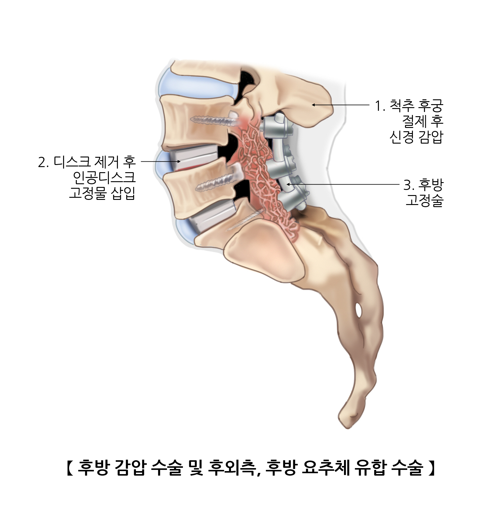 후방 감압 수술ㆍ후외측, 후방 요추체 유합 수술
