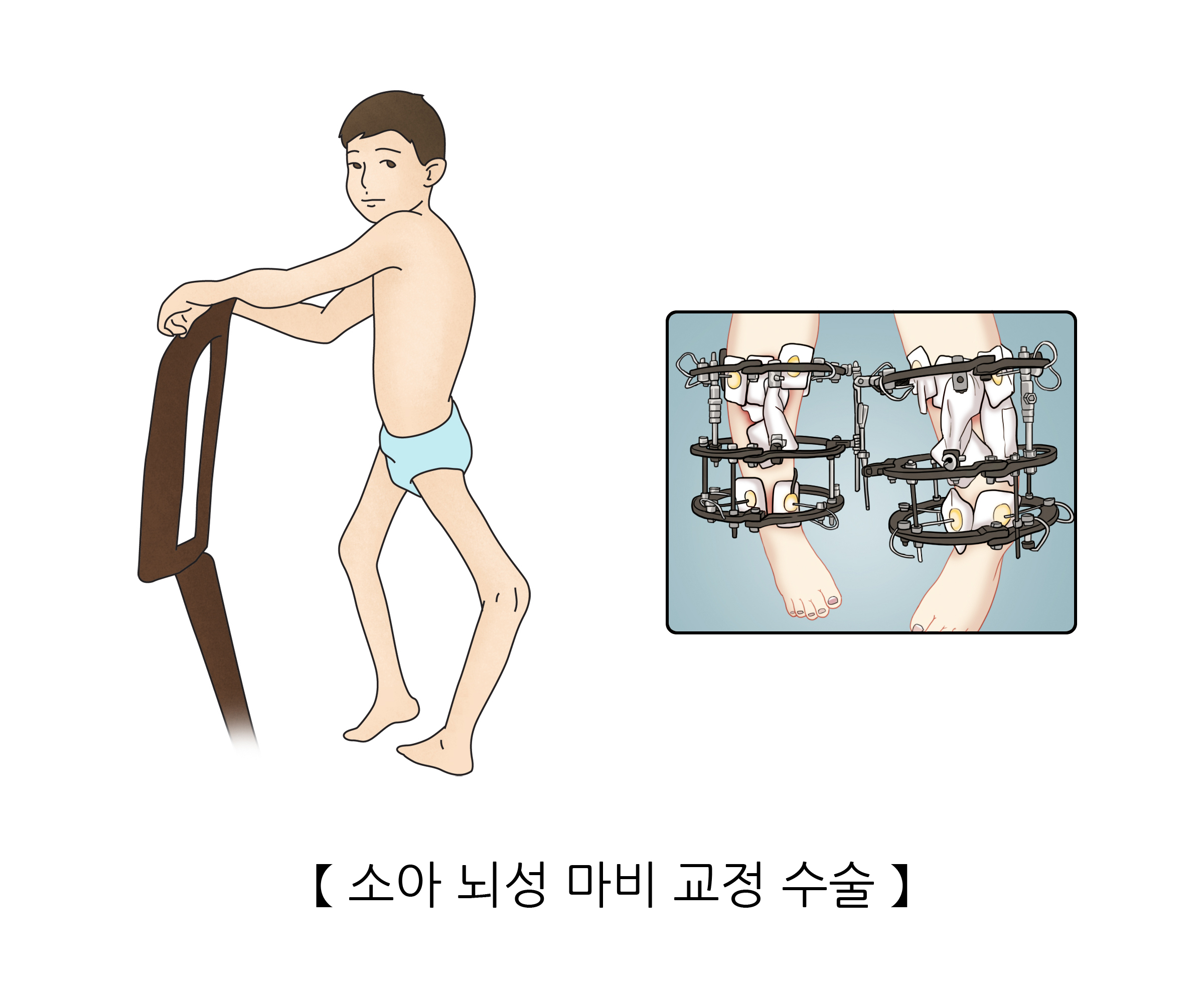소아 뇌성 마비 교정 수술