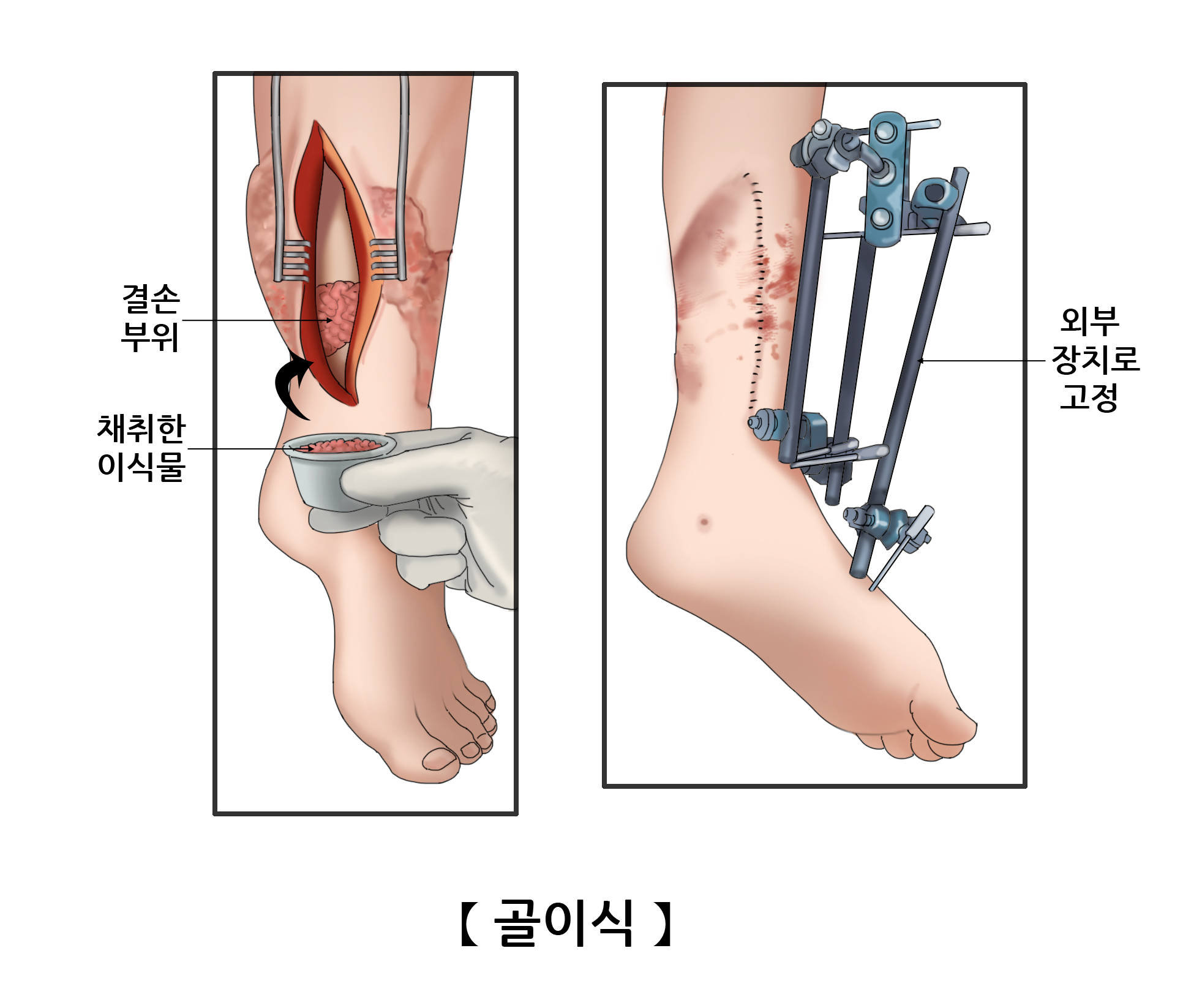 골이식