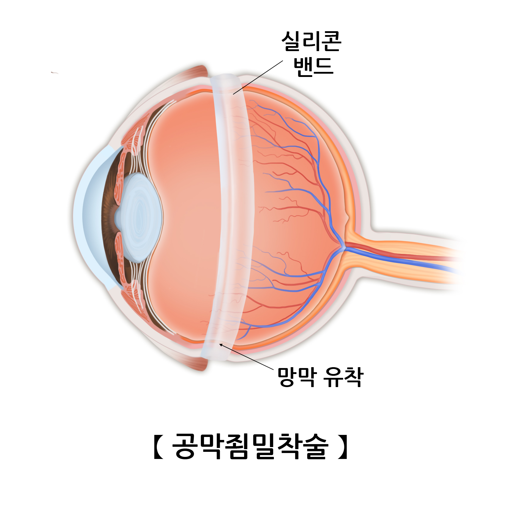 공막죔밀착술