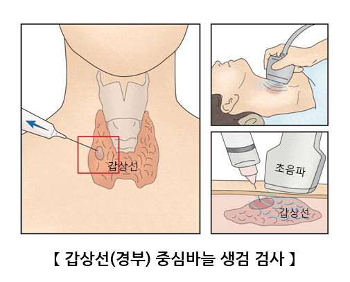 갑상선(경부) 중심바늘 생검 검사