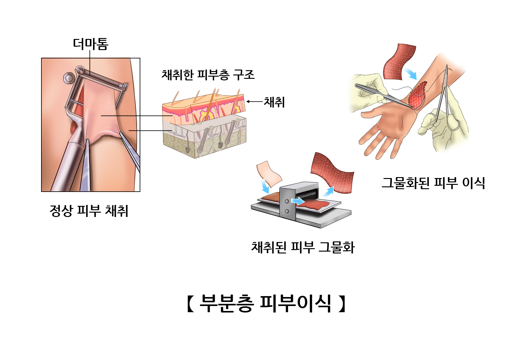 부분층 피부이식