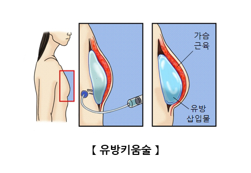 유방키움술