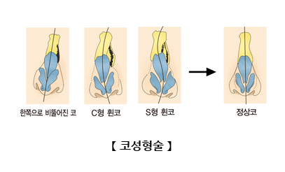 코성형술