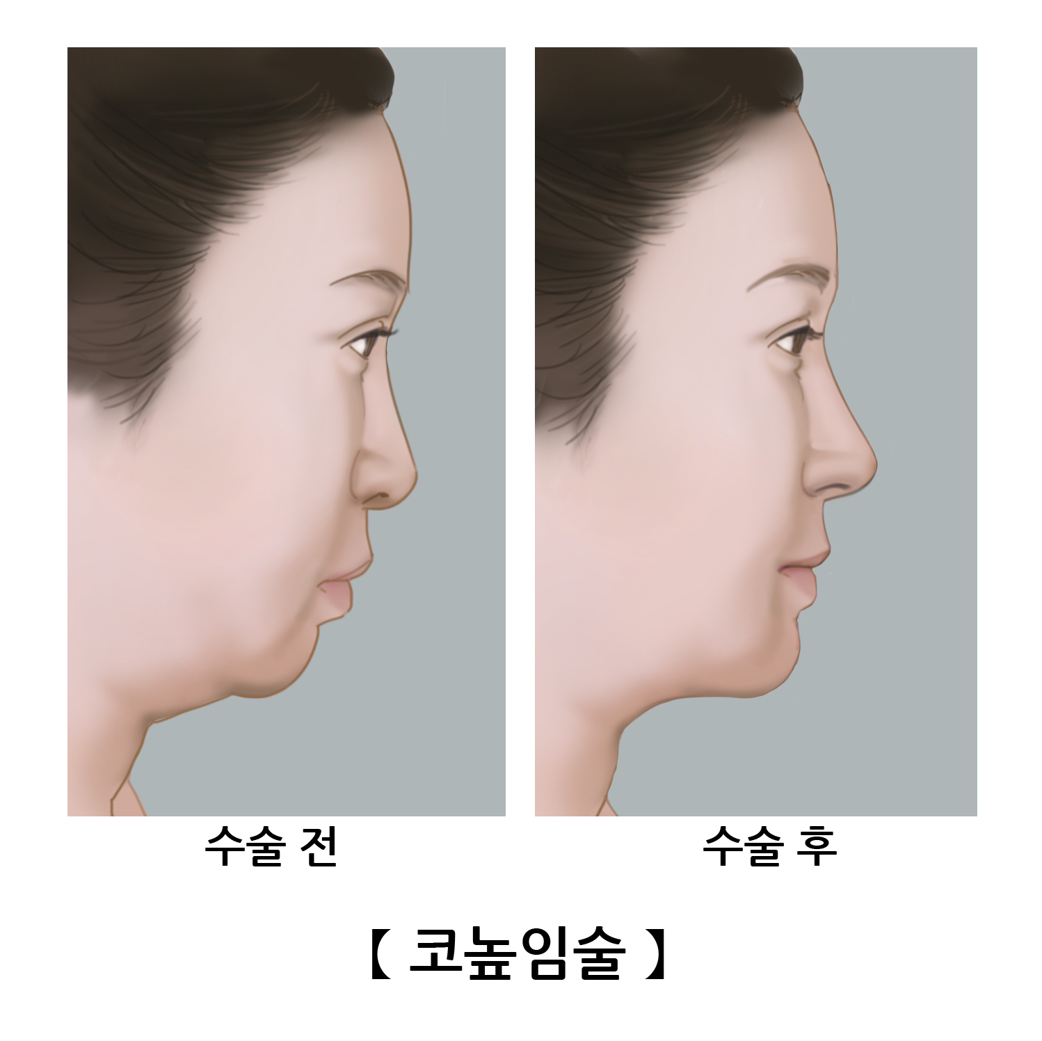 코높임술