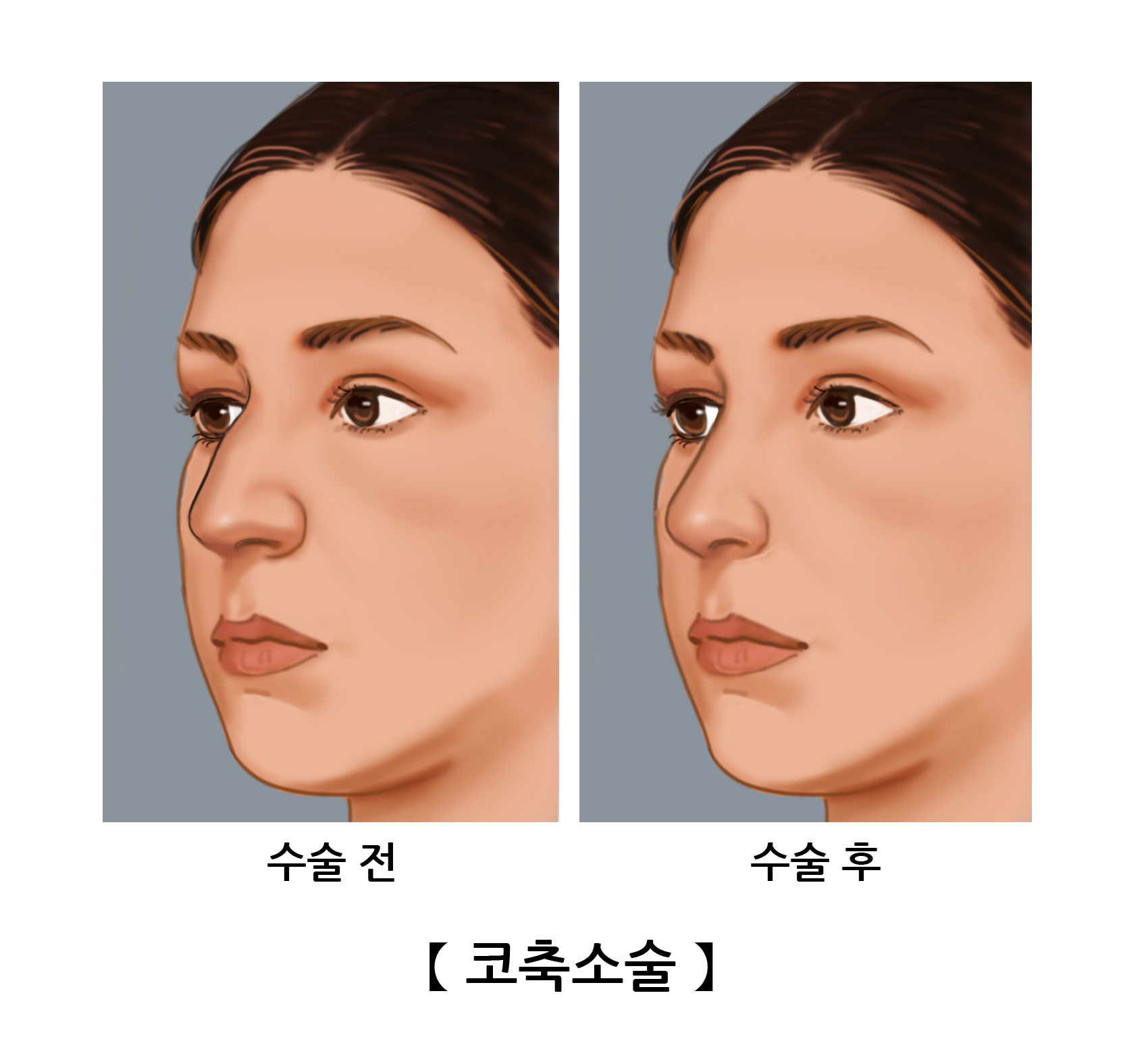 코축소술