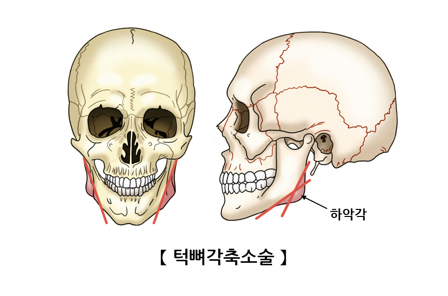 턱뼈각축소술