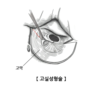 고실성형술
