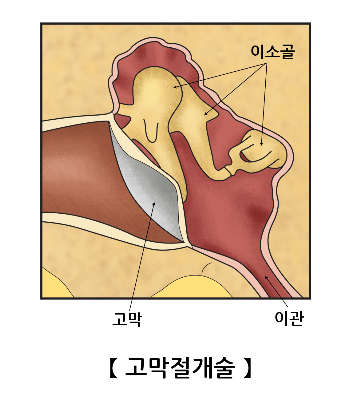 고막절개술 | 검사/시술/수술정보 | 의료정보 | 건강정보 | 서울아산병원