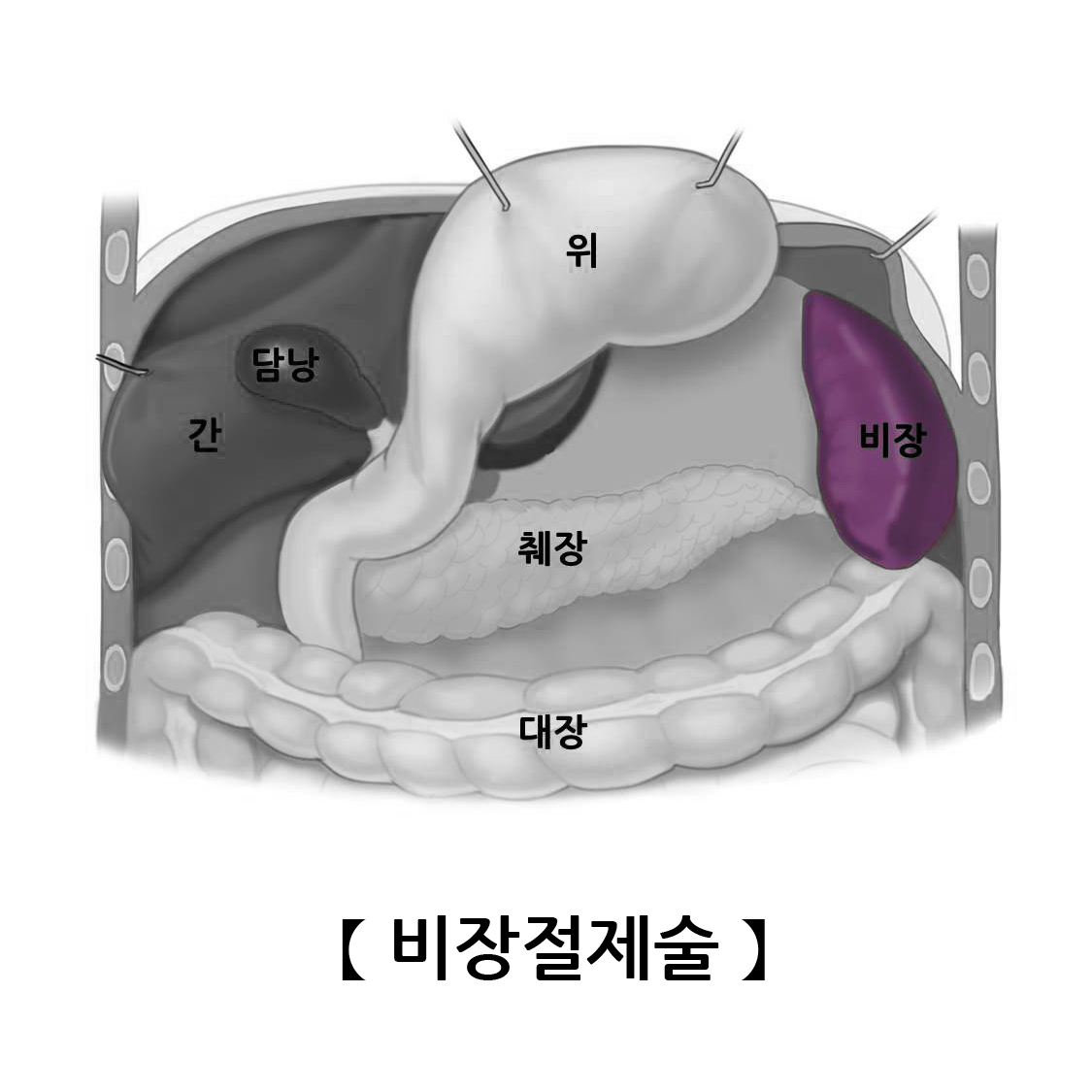 비장절제술 | 검사/시술/수술정보 | 의료정보 | 건강정보 | 서울아산병원