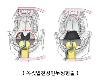 구개수구개인두성형술