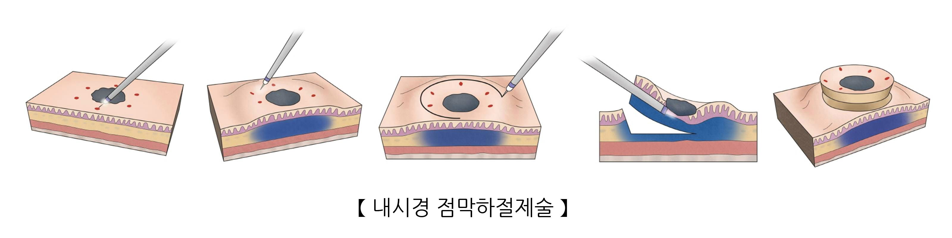 내시경 점막하절제술