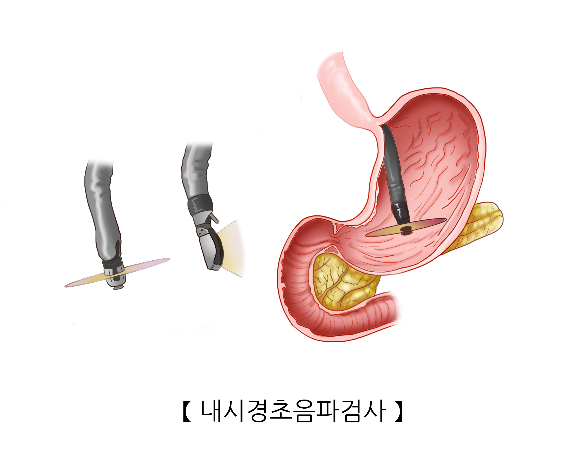 내시경 초음파 검사