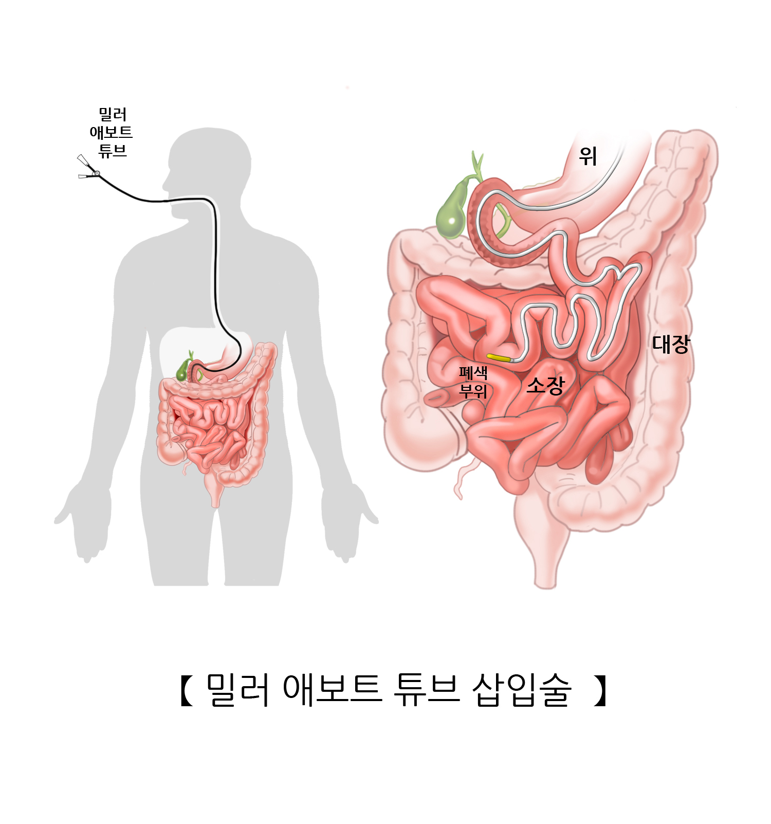 밀러 애보트 튜브 삽입술