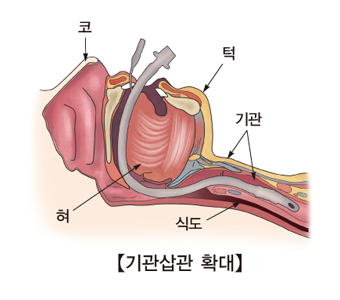 기관삽관 확대