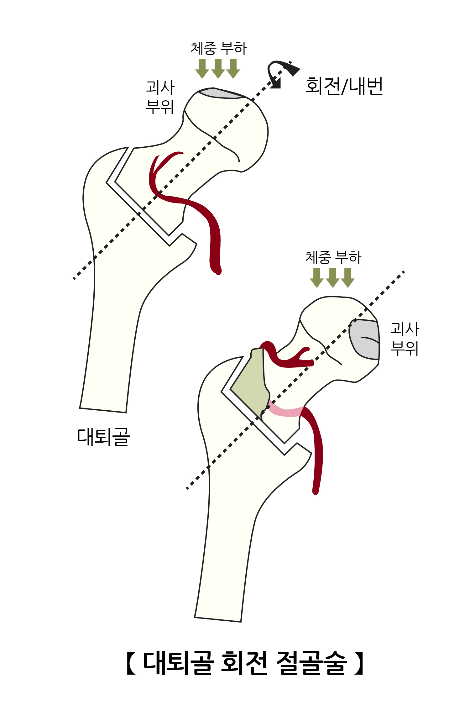 대퇴골 회전 전골술