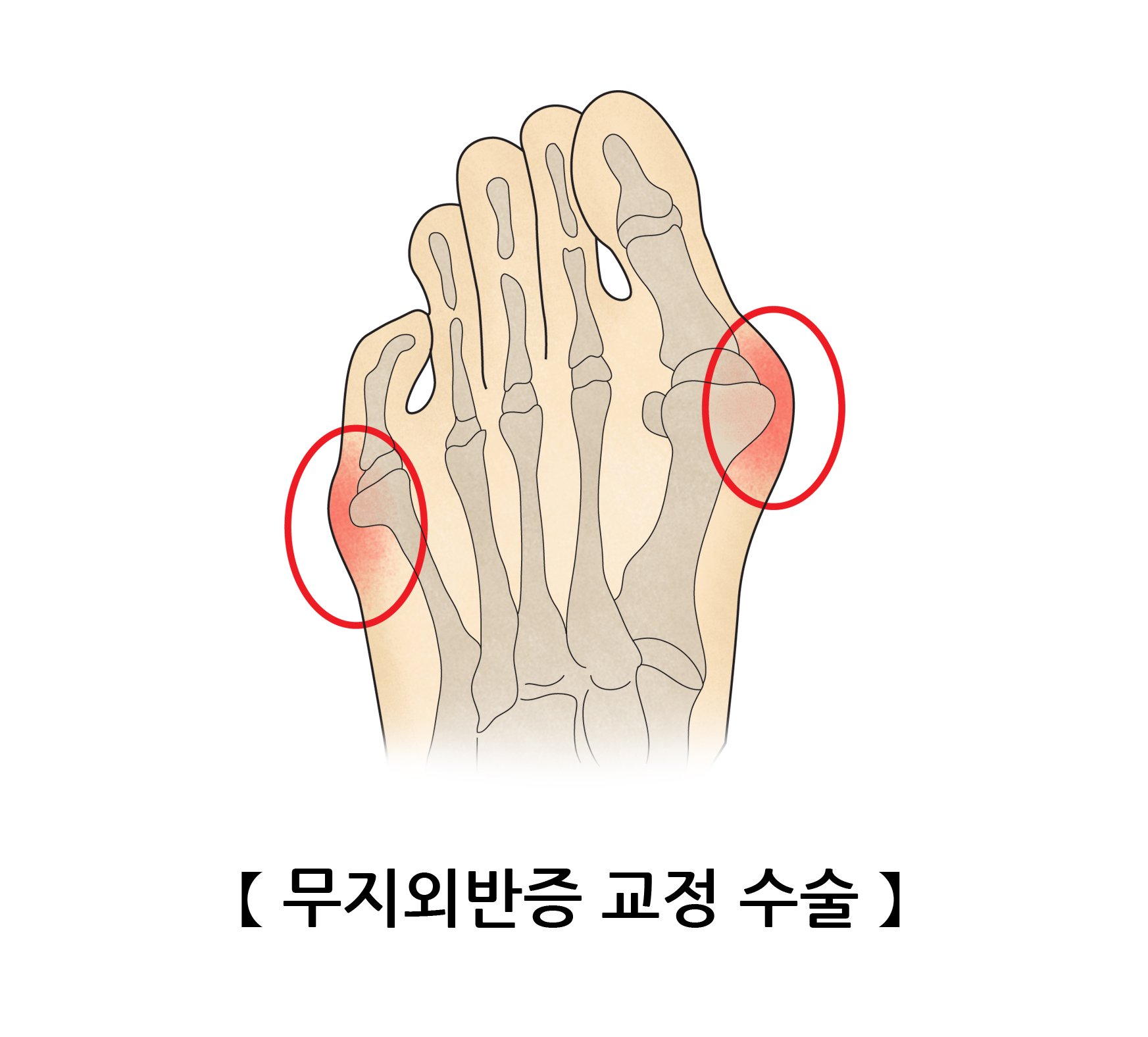 무지외반증 교정 수술