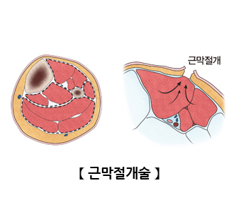 근막절개술
