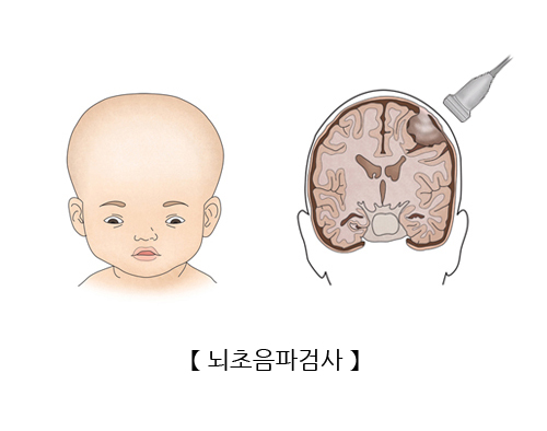 뇌초음파검사