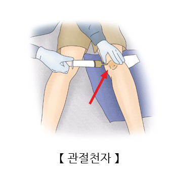 관절천자