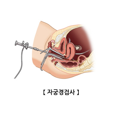자궁경검사