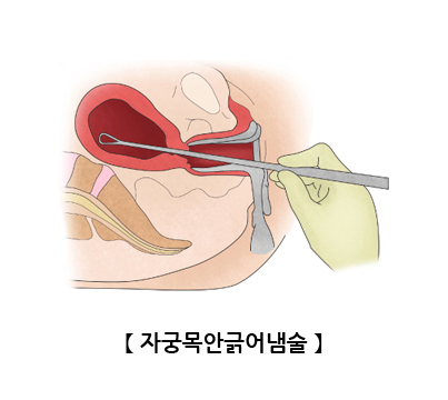 자궁목안긁어냄술