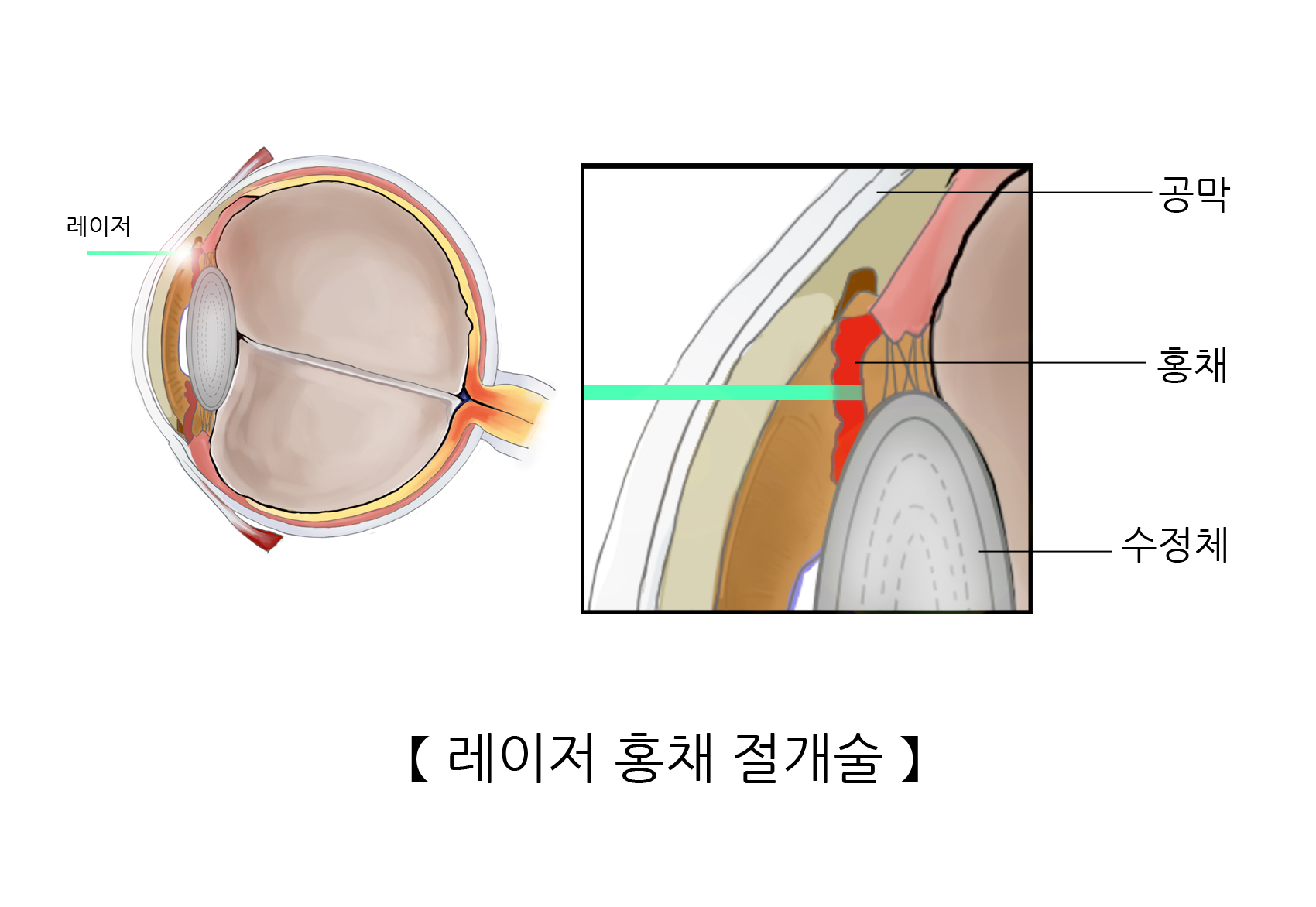 레이저 홍채 절개술