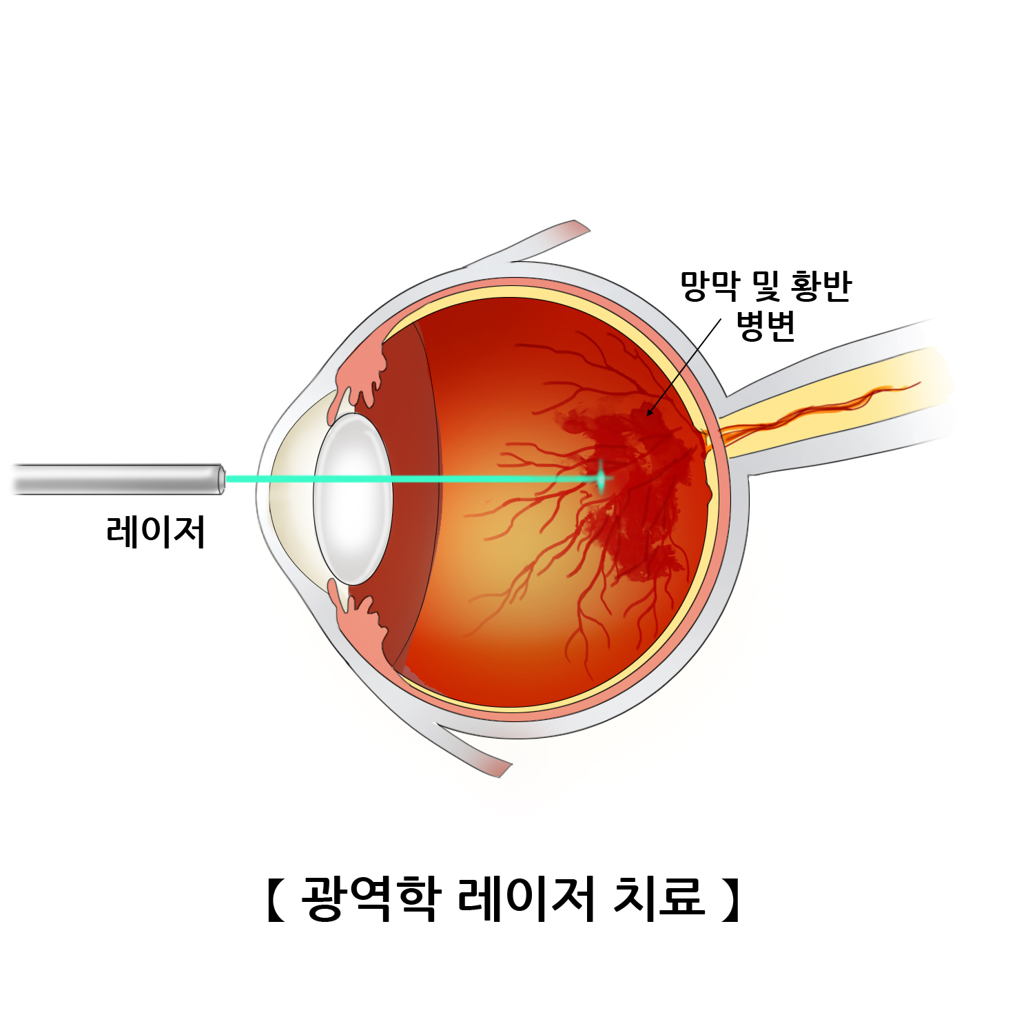 광영학 레이저 치료