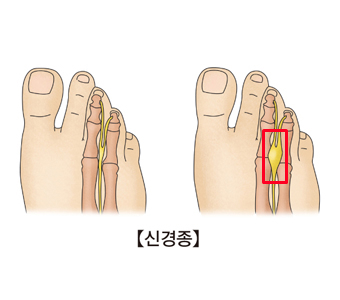 신경봉합술