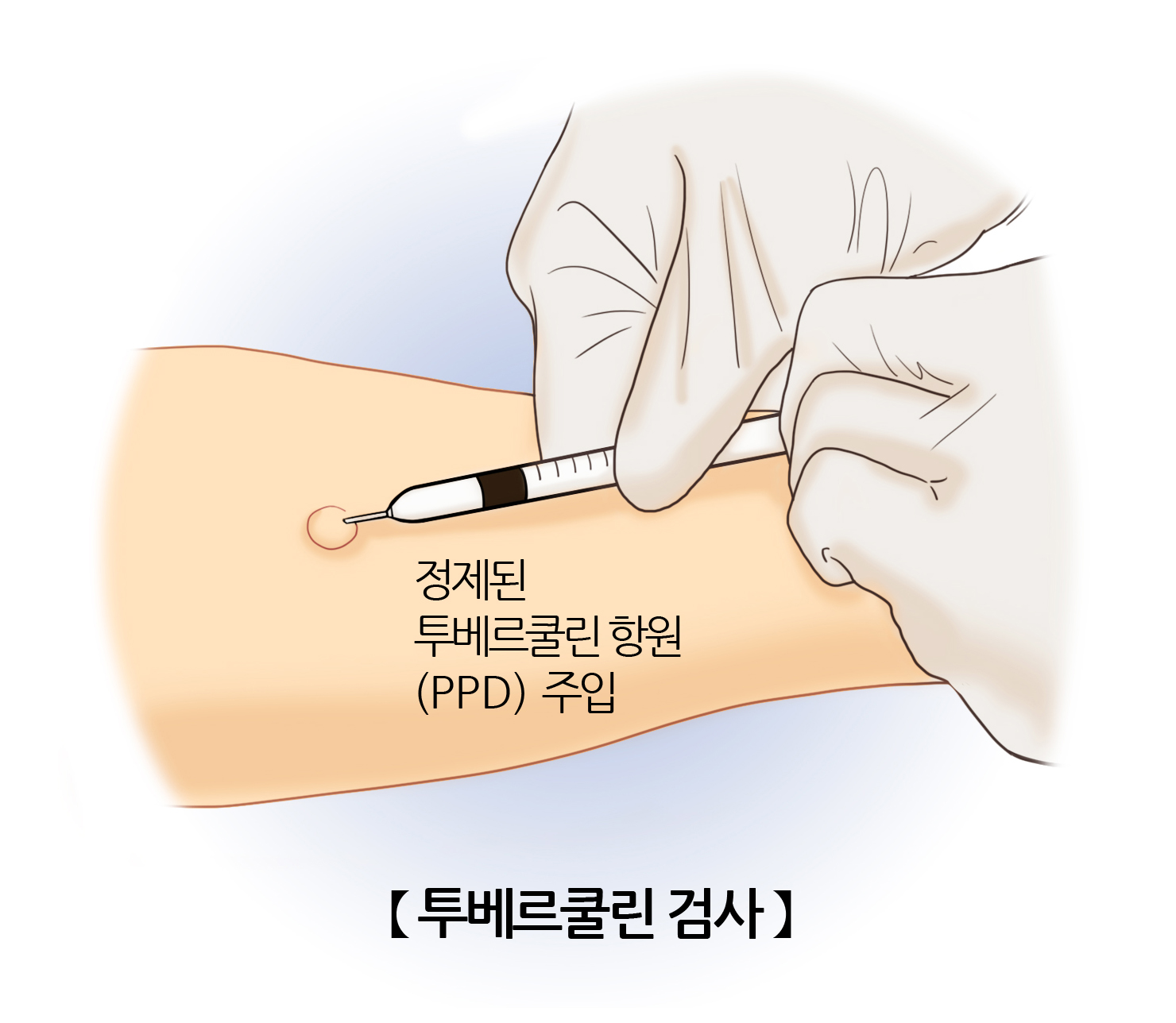 투베르쿨린 검사