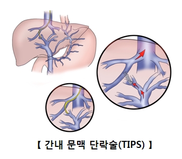 간내 문맥 단락술