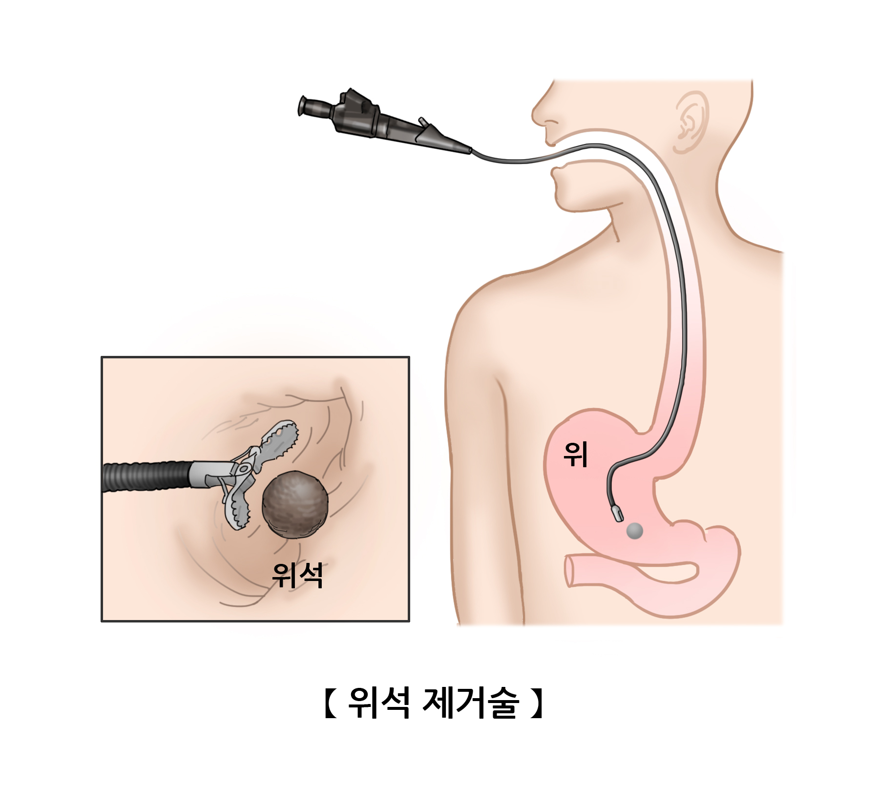 위석 제거술