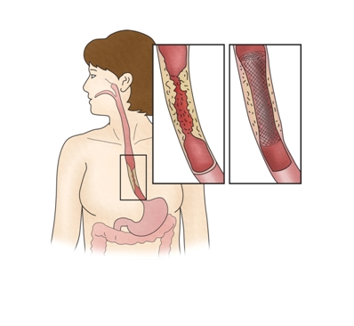 식도, 위 스텐트 삽입술