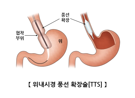위내시경 풍선 확장술[TTS]