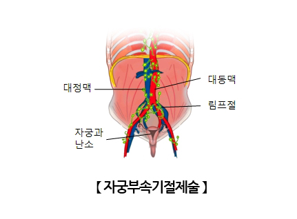 자궁부속기절제술