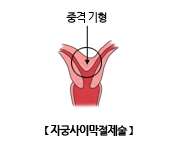 자궁사이막절제술