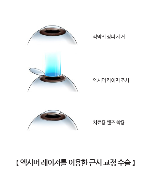 엑시머 레이저를 이용한 근시 교정 수술
