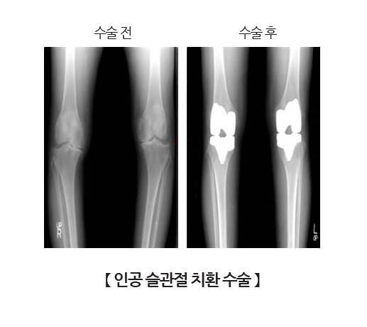 인공 슬관절 치환 수술