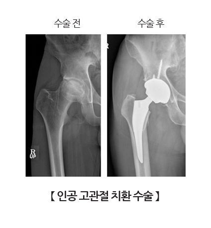 인공 고관절 치환 수술