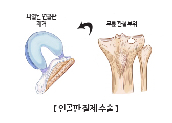 연골판 절제 수술