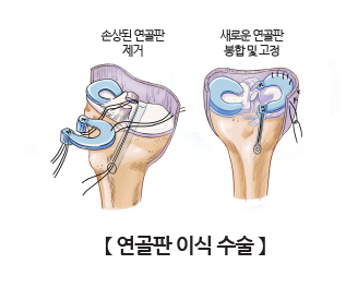 연골판 이식수술